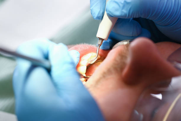 Best Emergency Tooth Extraction in Hebron, IN